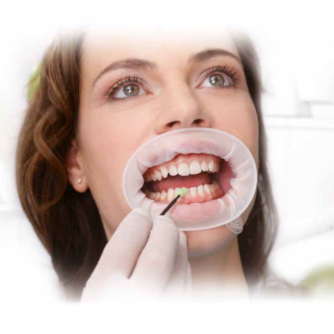 Ecarteur optragate 3d, Fourniture dentaire, Equipement dentiste